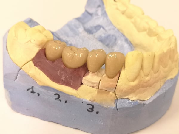 Zahnersatz : Kronen auf Implantaten und eigenen Zähnen