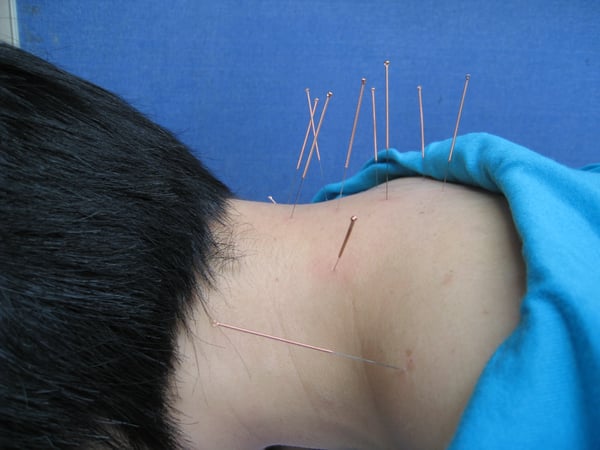 Akupunktur