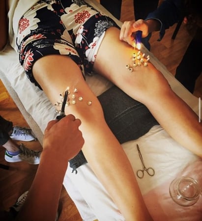 Acupuncture