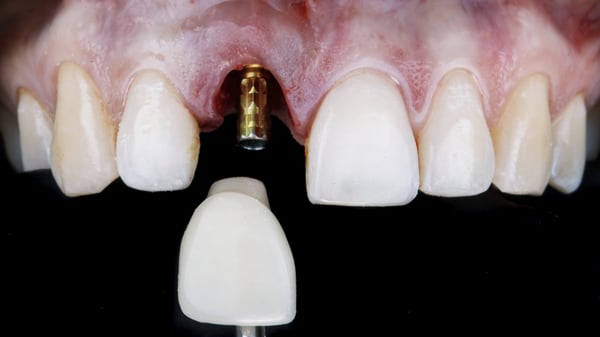 Implant dentaire à Meyrin et à Genève