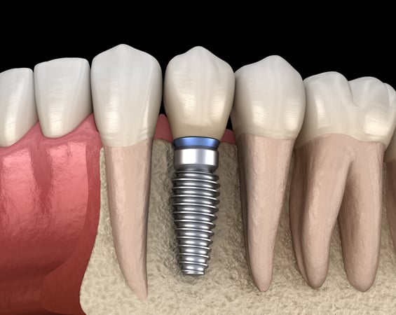 Implants dentaires Straumann 100% suisse de qualité supérieure !