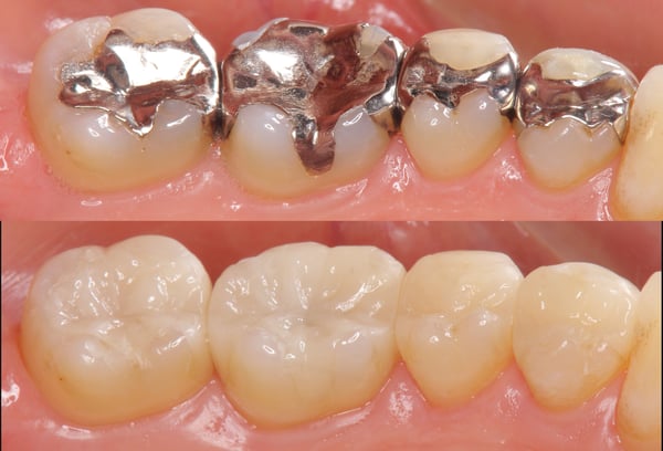 remplacement de plombage de haute qualité par nos dentistes à la clinique dentaire de meyrin