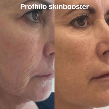 Profhilo ist eine biostimulierende Gesichtsbehandlung, die eine fördert die Hautfeuchtigkeit von innen, was zu einem frischeren und strahlenderen Aussehen führt.