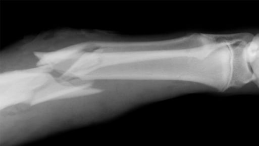 Image of broken bone x-ray