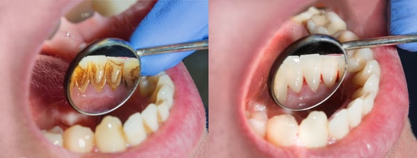 Détartrage dentaire à meyrin et à genève par nos hygiénistes et dentiste