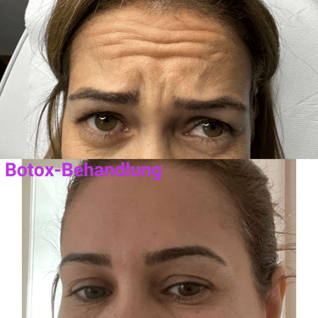 Botox Behandlung... Frischeres, jugendlicheres Aussehen mit sichtbarer Reduzierung von Falten und Mimikfalten: Stirn, Augenring, Glabella.