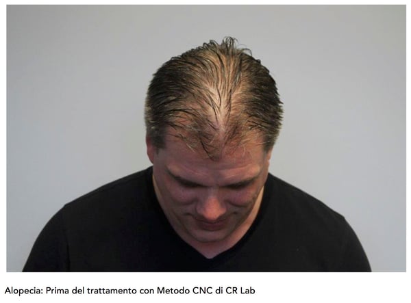 Alopecia androgenetica maschile uomo prima del trattamento con Metodo CNC di CRLab