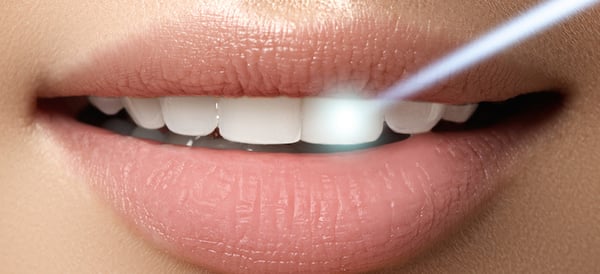 laser dentale