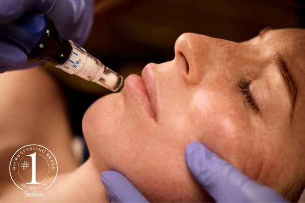 SkinPen Rebate