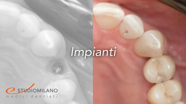 esempio di implantologia a lugano