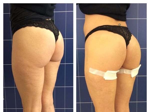 Lipofilling glutei