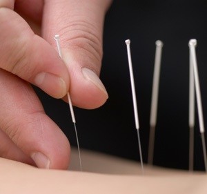 acupuncture et médecine chinoise