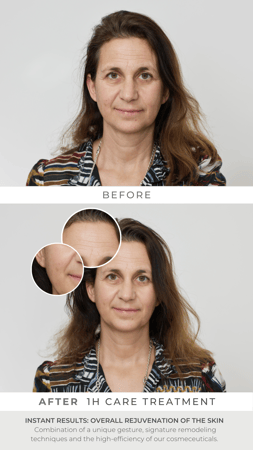 Before and after NESCENS Facial
